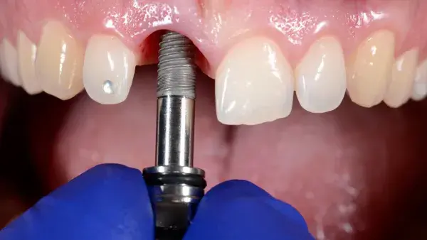 implantes dentários